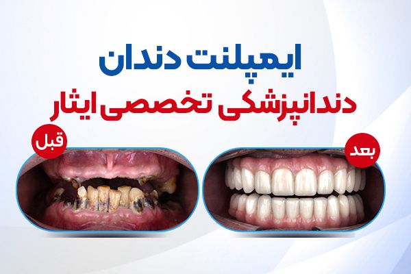 ایمپلنت و ارتودنسی و کامپوزیت دندان
